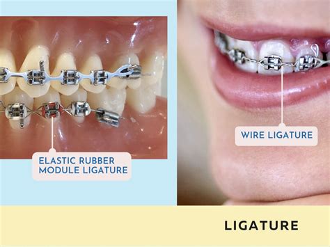 doe all metal braces brackets need wire|braces wire diagram.